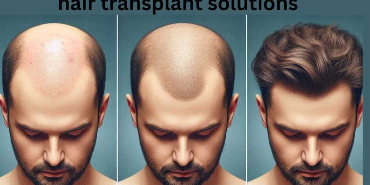 Exploring Different Types of Hair Transplant Solutions