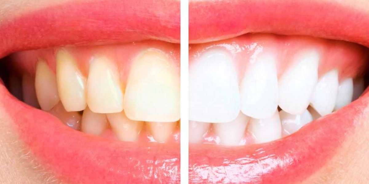 Auckland’s best teeth whitening? Discover The Whitening Co’s Services