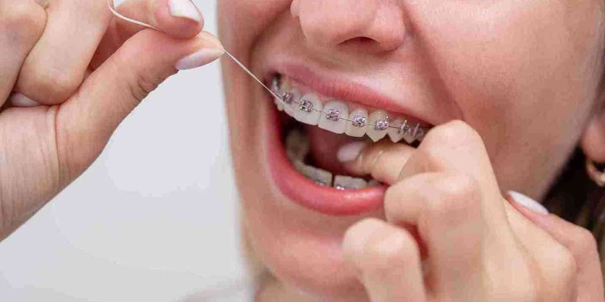 4 Key Advantages of Choosing Invisalign Over Traditional Braces