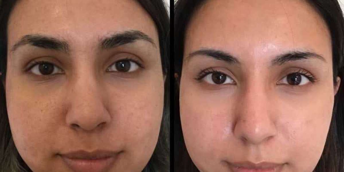 Experience Youthful Skin with CO2 Laser Resurfacing