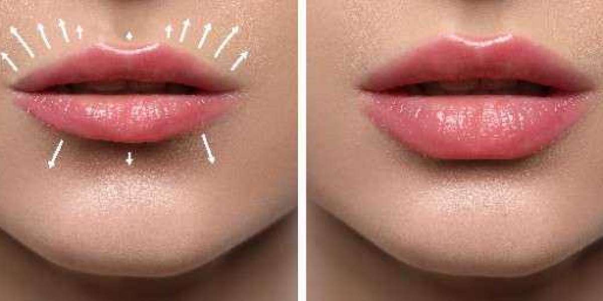 Get Beautiful, Natural-Looking Lips at Your Dentist’s Office