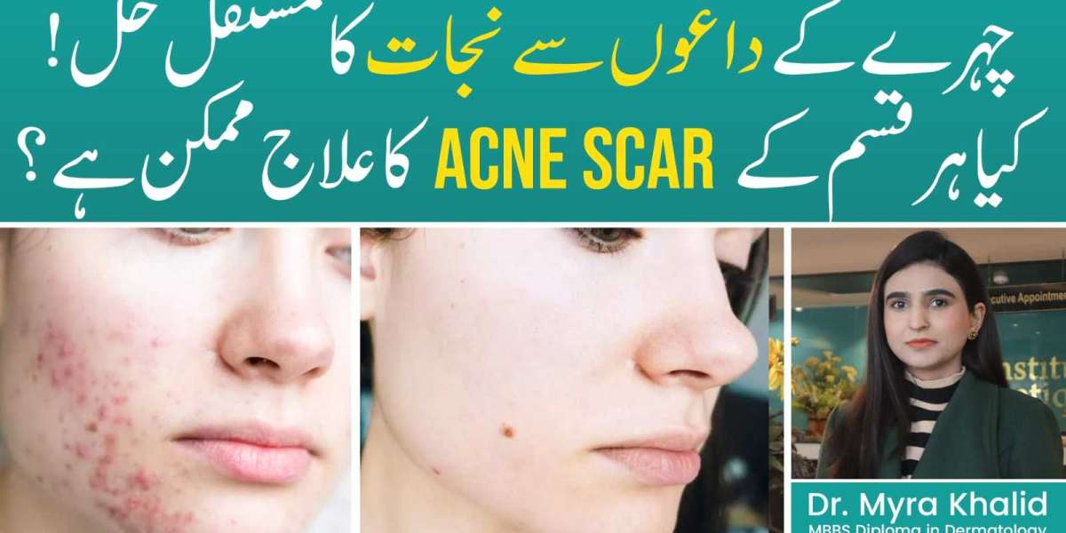 Best Acne Scar Treatments That Show Fast and Lasting Results